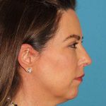Chin Implant Before & After Patient #1659