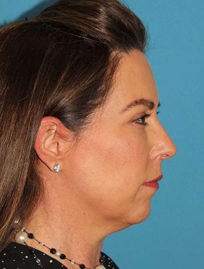 Chin Implant Before & After Patient #1659