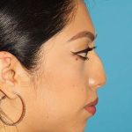 Chin Implant Before & After Patient #1670
