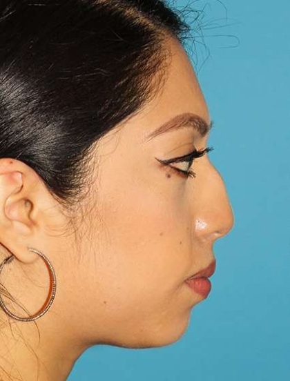 Chin Implant Before & After Patient #1670