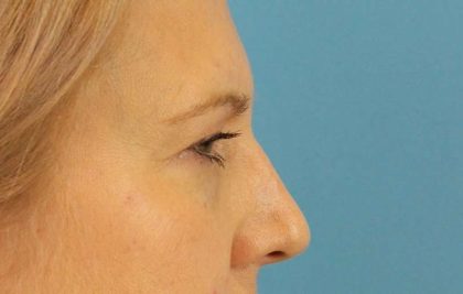 Eyelid Lift Before & After Patient #1747