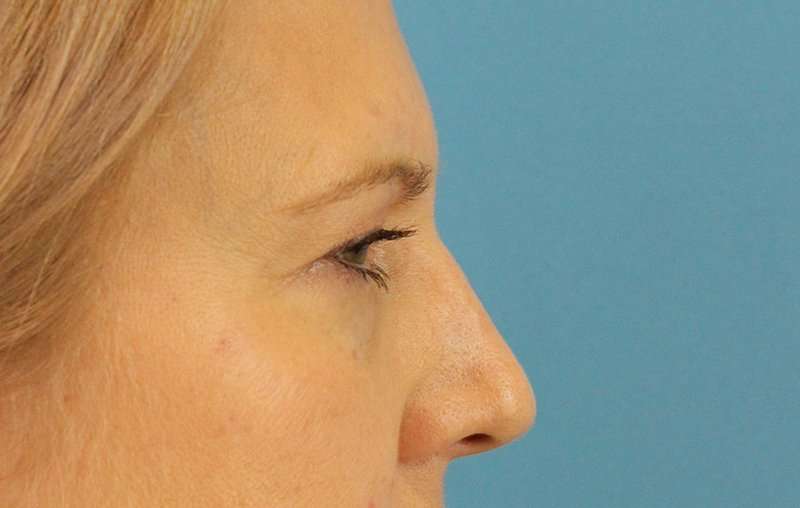 Eyelid Lift Before & After Patient #1747