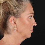Facelift Before & After Patient #1778