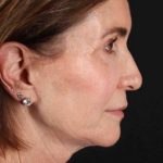 Facelift Before & After Patient #1789