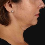 Facelift Before & After Patient #1809