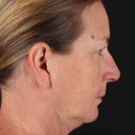 Facelift Before & After Patient #1831