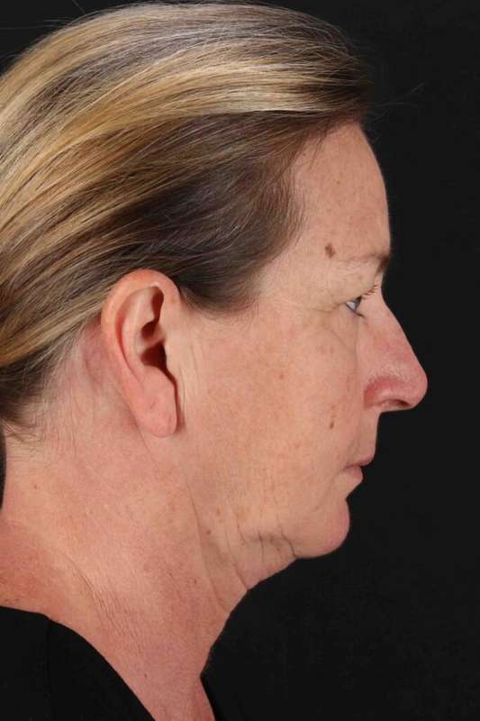 Facelift Before & After Patient #1831