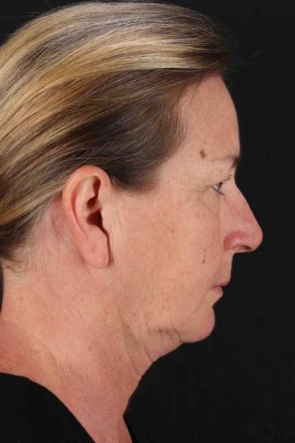 Browlift Before & After Patient #1264