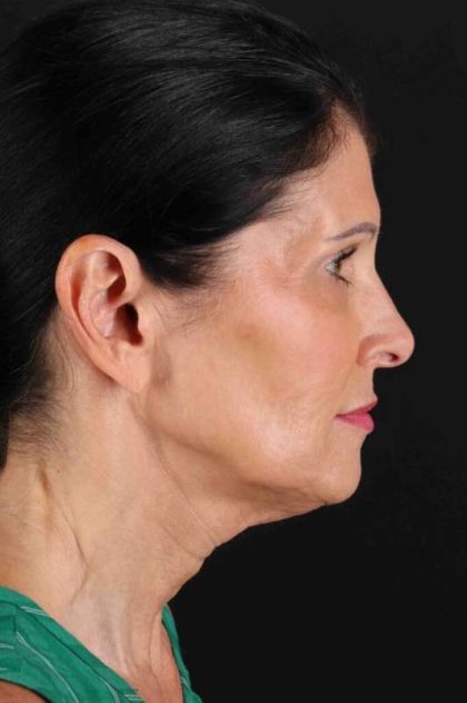 Facelift Before & After Patient #1854