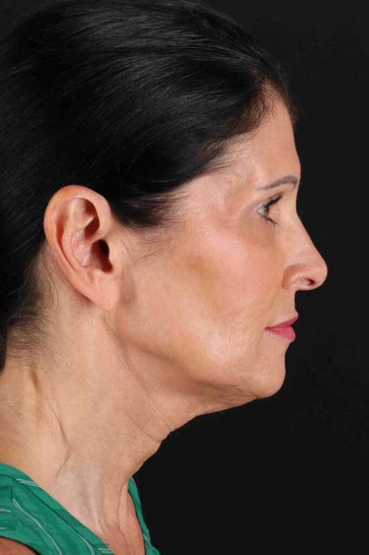 Facelift Before & After Patient #1854