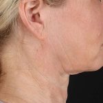 Facelift Before & After Patient #1866