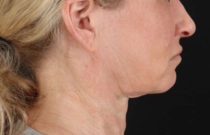 Facelift Before & After Patient #1866