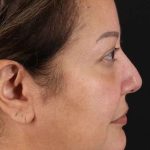 Facelift Before & After Patient #1888