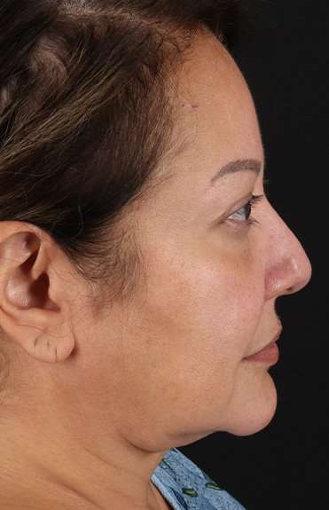 Facelift Before & After Patient #1888