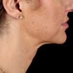 Facelift Before & After Patient #1921
