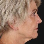 Facelift Before & After Patient #1943