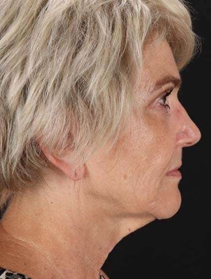 Facelift Before & After Patient #1943