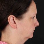 Browlift Before & After Patient #1275