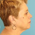 Facelift Before & After Patient #1975