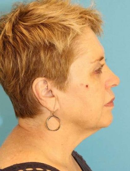 Facelift Before & After Patient #1975