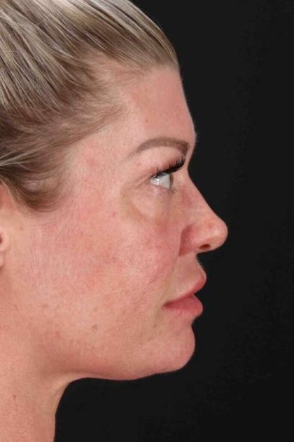 Fat Grafting To The Face Before & After Patient #2016