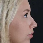 Fillers Before & After Patient #2030