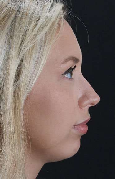 Fillers Before & After Patient #2030