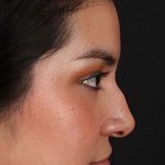 Fillers Before & After Patient #2041