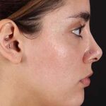 Fillers Before & After Patient #2052