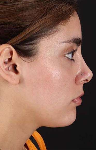 Fillers Before & After Patient #2052