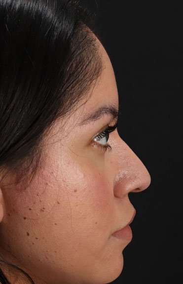 Fillers Before & After Patient #2063