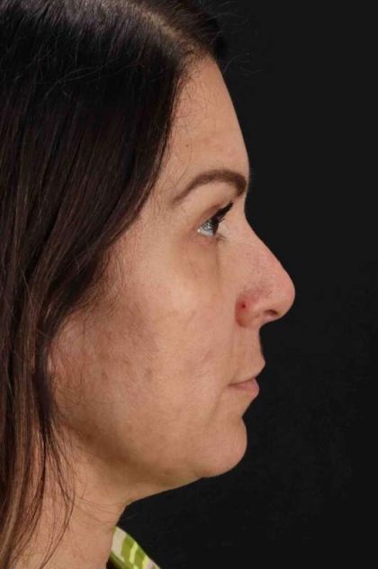 Lip Lift Before & After Patient #2133