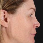 Lip Lift Before & After Patient #2144