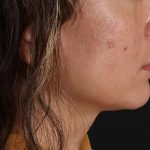 Lip Lift Before & After Patient #2166