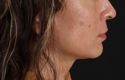 Lip Lift Before & After Patient #2166