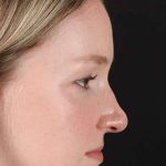 Liquid Rhinoplasty Before & After Patient #2177