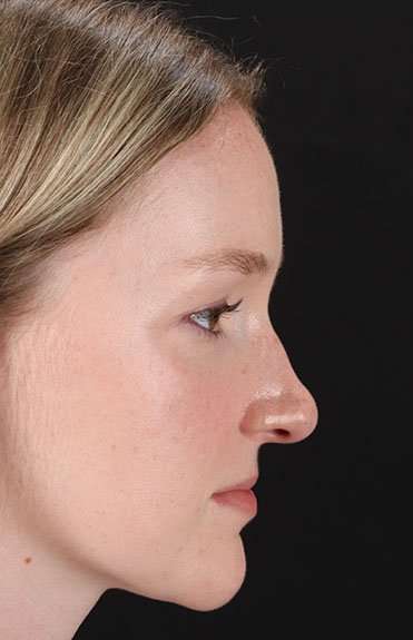 Liquid Rhinoplasty Before & After Patient #2177