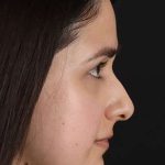 Liquid Rhinoplasty Before & After Patient #2188