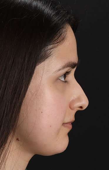 Liquid Rhinoplasty Before & After Patient #2188