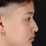 Liquid Rhinoplasty Before & After Patient #2199
