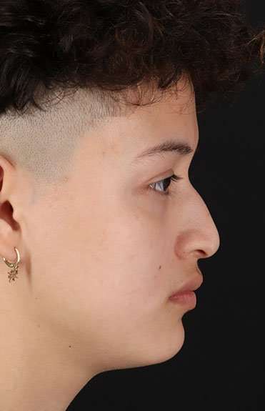 Liquid Rhinoplasty Before & After Patient #2199