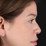 Liquid Rhinoplasty Before & After Patient #2210