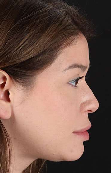 Liquid Rhinoplasty Before & After Patient #2210
