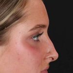 Liquid Rhinoplasty Before & After Patient #2221