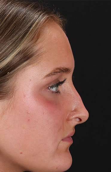 Liquid Rhinoplasty Before & After Patient #2221