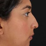 Liquid Rhinoplasty Before & After Patient #2232