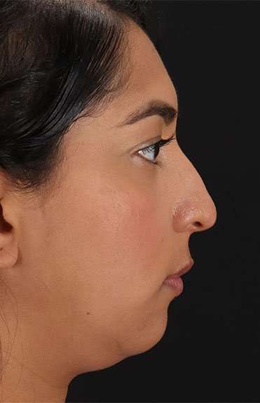 Liquid Rhinoplasty Before & After Patient #2232