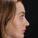 Browlift Before & After Patient #1297