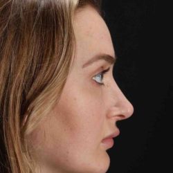 Browlift Before & After Patient #1297