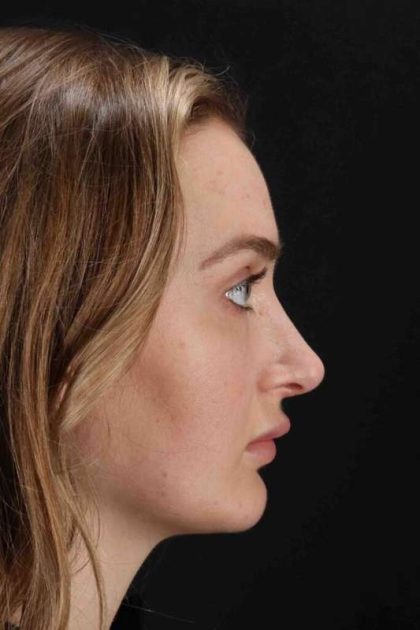 Browlift Before & After Patient #1297